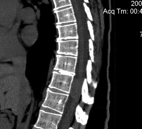 Thoracic Disc Calcified CT 2